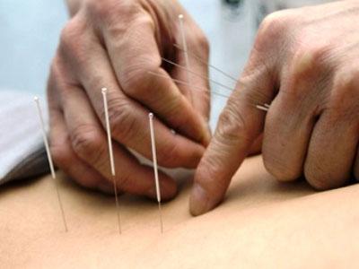 Istraživanja: Akupunktura pomaže kod alergija