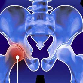 Da li će operacija zamjene kuka postati stvar prošlosti?