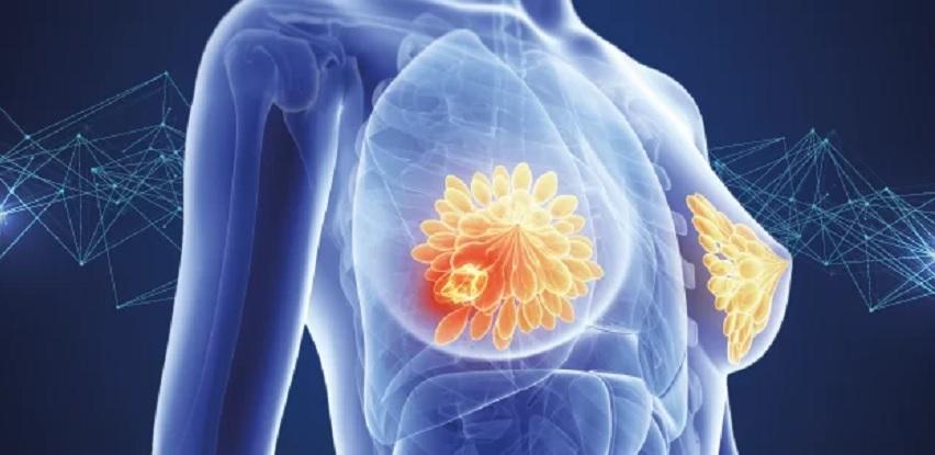 Kantonalmna bolnica Zenica zloćudni tumor dojke