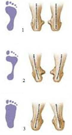 Deformiteti stopala: 1. Normalan položaj, 2. Podignut svod, 3. Spušten svod