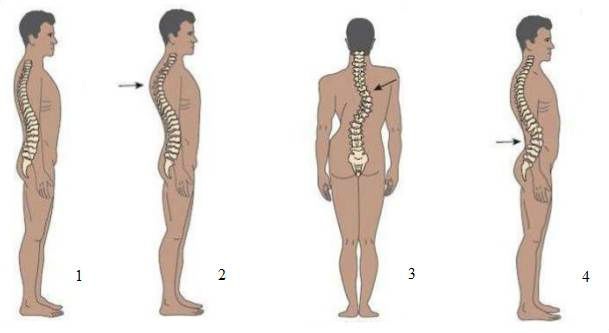 Tipovi deformiteta kičme: 1. Normalan položaj, 2. Kifoza, 3. Skolioza, 4. Lordoza