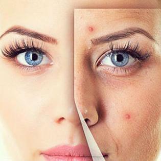 Novo u Herbal Spa - Dubinsko čišćenje lica sa dodatkom hijalurona
