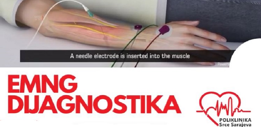 EMNG pregled – Elektromiografija (EMNG) dijagnostički test u Poliklinici Srce Sarajeva