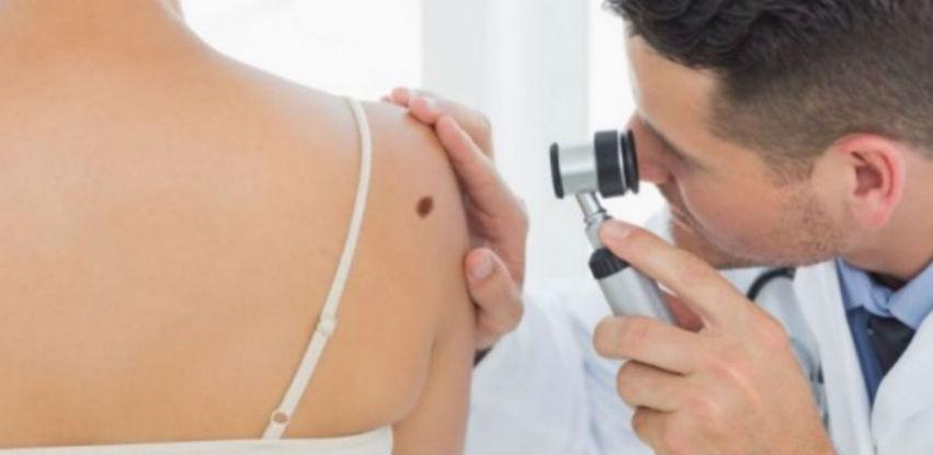 INZ i KB Zenica organizuju besplatni pregled - Skrining na melanom kože